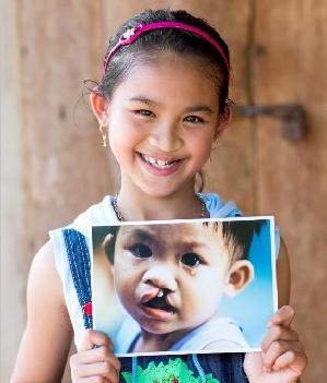 Operation Smile Impact